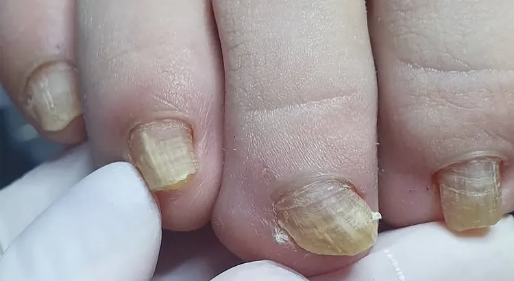 tratamiento uñas podologia