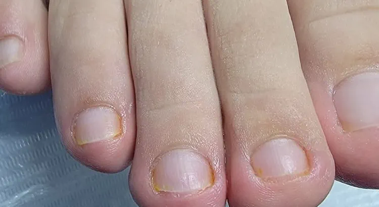 tratamiento uñas podologia