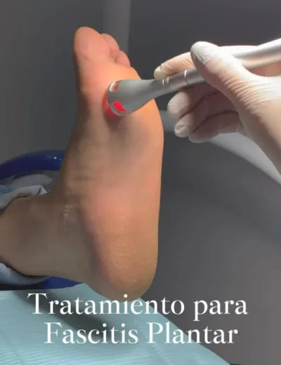 Tratamiento Fascitis plantar