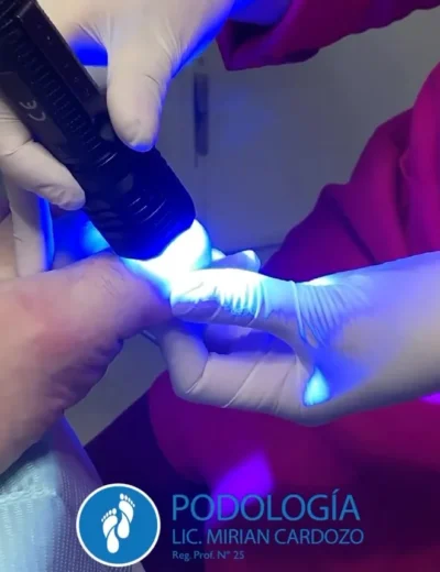 Tratamiento Laser Mirian Cardozo