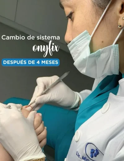Tratamiento Onyfix
